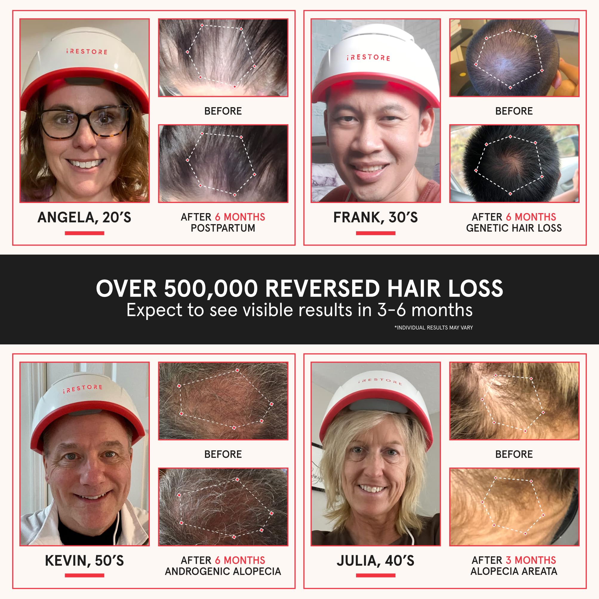 iRestore Professional Laser Red Light Therapy Hair Growth System - FDA Cleared Hair Loss Treatment for Men & Women - 282 Lasers & LEDs Laser Cap for Hair Regrowth - Effective for Alopecia & Thinning Hair - Perfect for Home Use & Salon Treatments