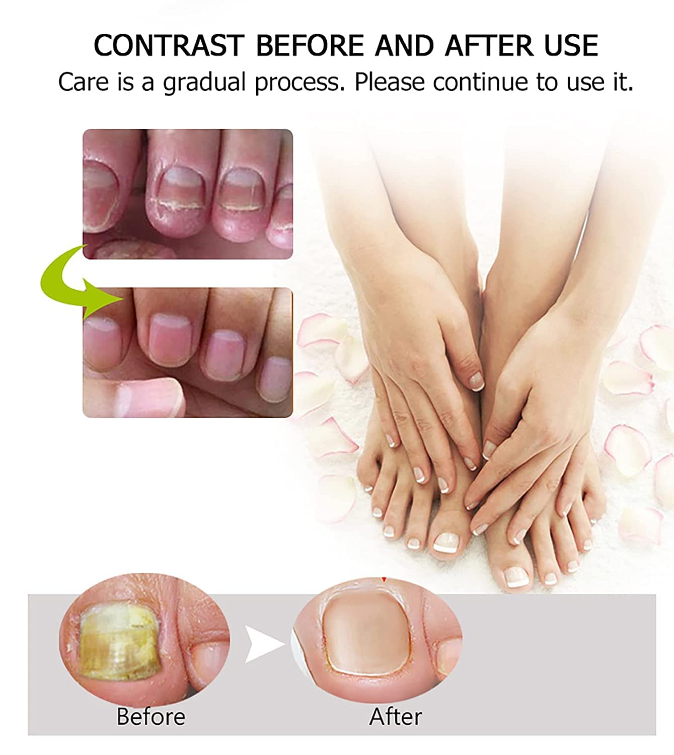 Flyles Nail Repair Treatment Gel - Restores Discolored & Damaged Nails, Strengthens & Protects Natural Nails (2 Pack) | Perfect for Manicures, Nail Care Routine & Salon Treatments