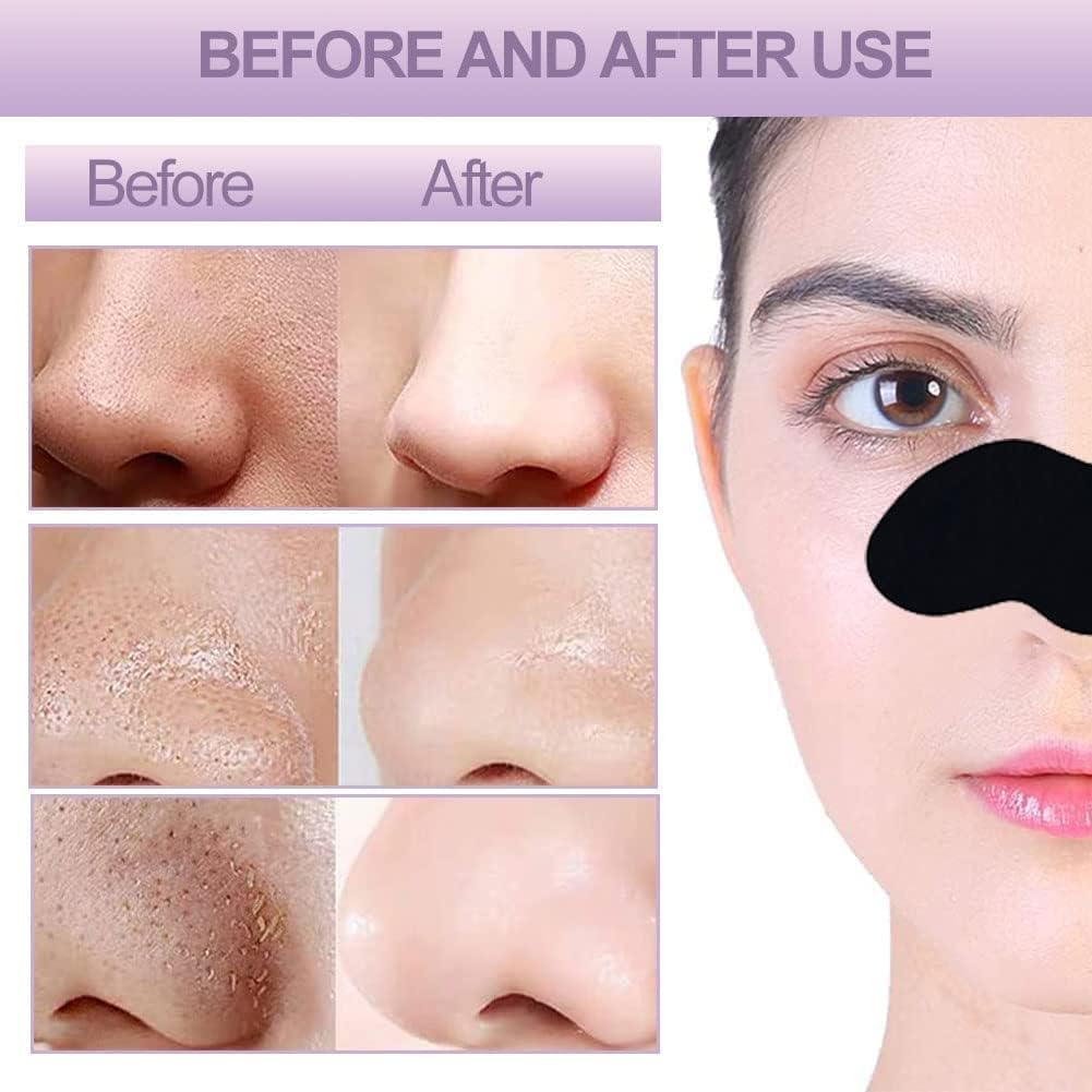 6-in-1 Blackhead & Whitehead Remover Tool - Professional Pimple Extractor, Acne Treatment & Pore Vacuum Cleaner for Men & Women (White/Black) | Perfect for Home Skincare & Facial Spa Treatment