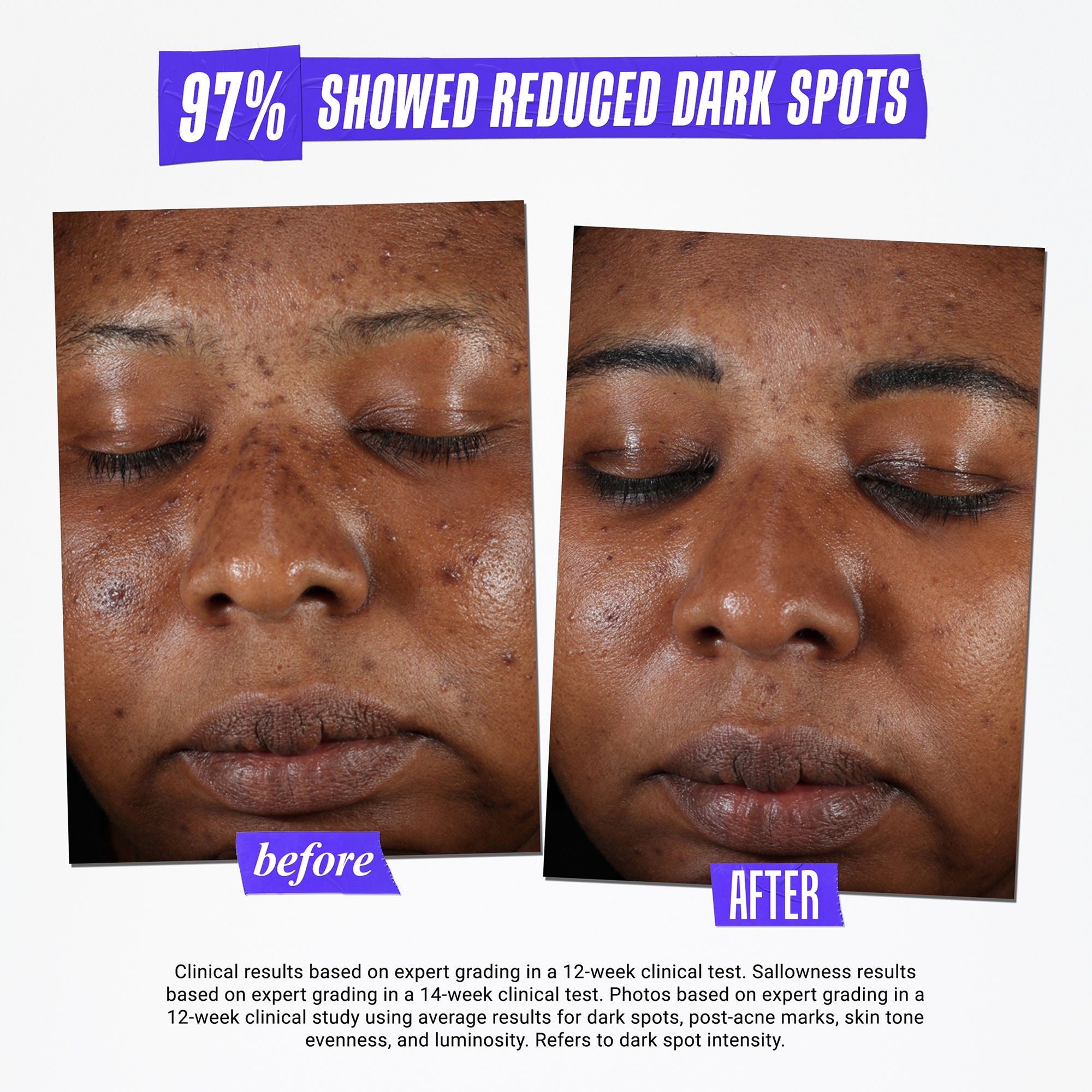Kiehl's Clearly Corrective Dark Spot Solution - Brightening Serum for Hyperpigmentation & Uneven Skin Tone | Perfect for Daily Skincare Routine & Nighttime Use