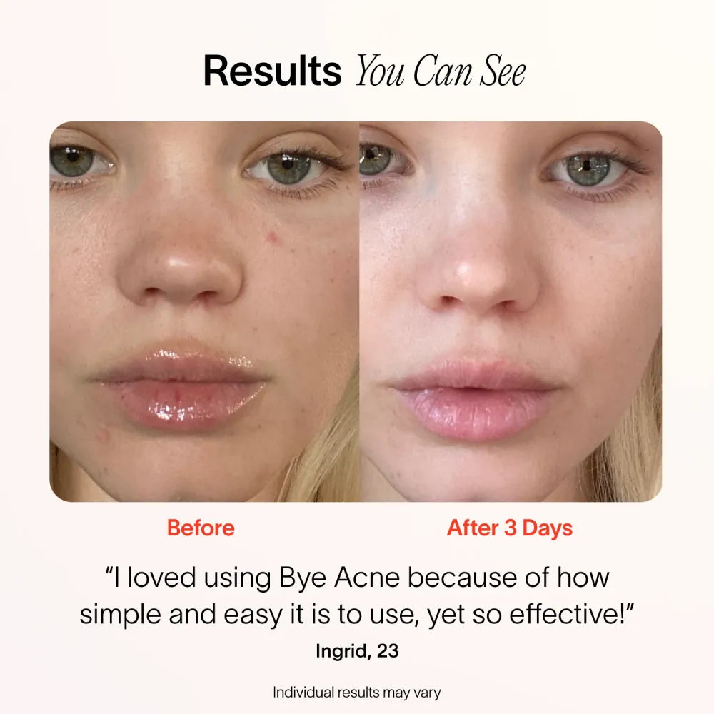 Bye Acne: Fast-Acting 3 Minute Pimple Spot Treatment for Clear Skin | Perfect for Overnight Use & On-The-Go Acne Care