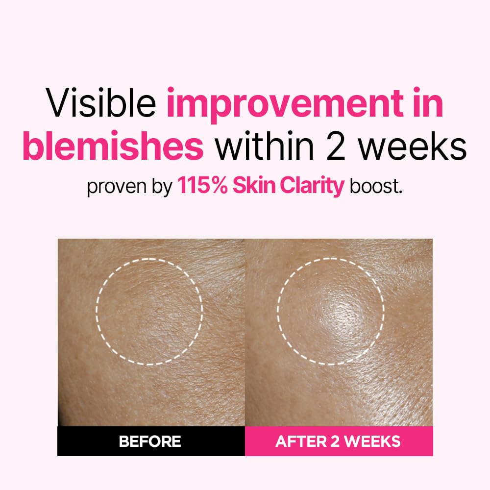 ISOI Blemish Care Up Serum - Vegan Hydrating Face Serum for Smooth & Glass Skin | Korean Skin Care for Skin Barrier Repair & Moisture Balance (1.18 fl oz/35ml) | Perfect for Acne-Prone & Sensitive Skin Daily Routine