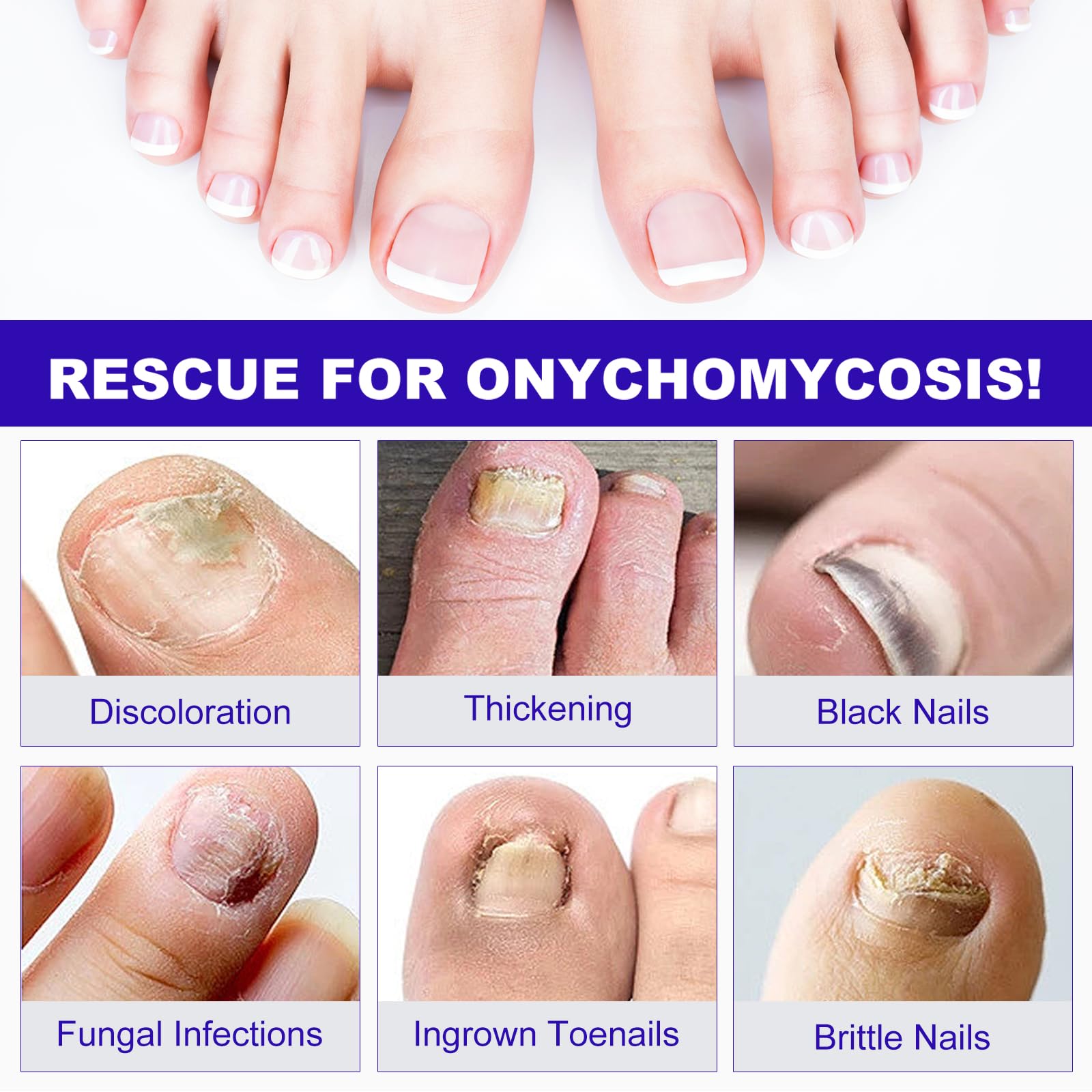Extra Strength Fungal Nail Treatment Patches with Undecylenic Acid - Repair Discolored & Thickened Toenails | Hypoallergenic & Waterproof | 24 Count | Ideal for Athletes, Swimmers & Active Lifestyles