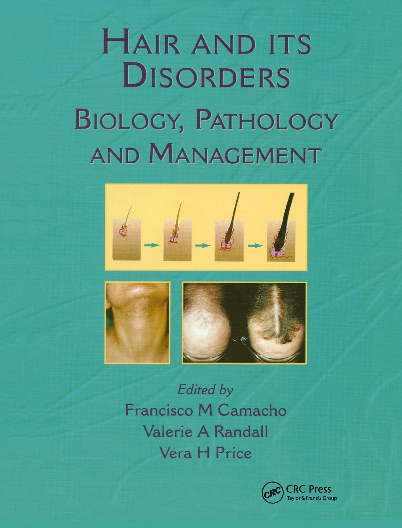 Hair and Its Disorders: Biology, Pathology and Management - Comprehensive Guide for Dermatologists & Trichologists | Clinical Practice & Research Reference