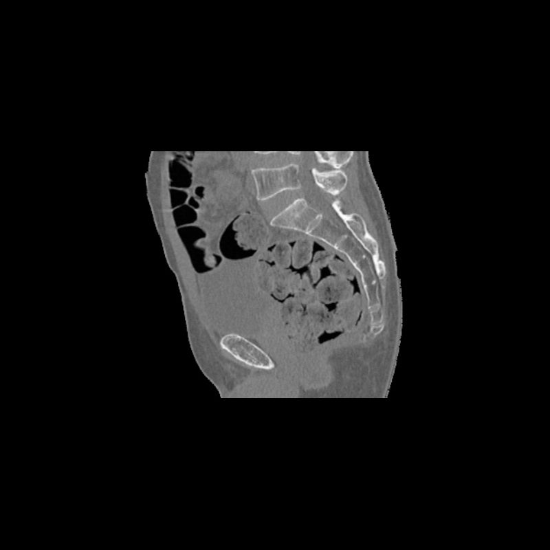 High-Quality Femoral Neck Fracture Pelvis Phantom for CT Scan & X-Ray Training - Perfect for Medical Education & Radiology Practice