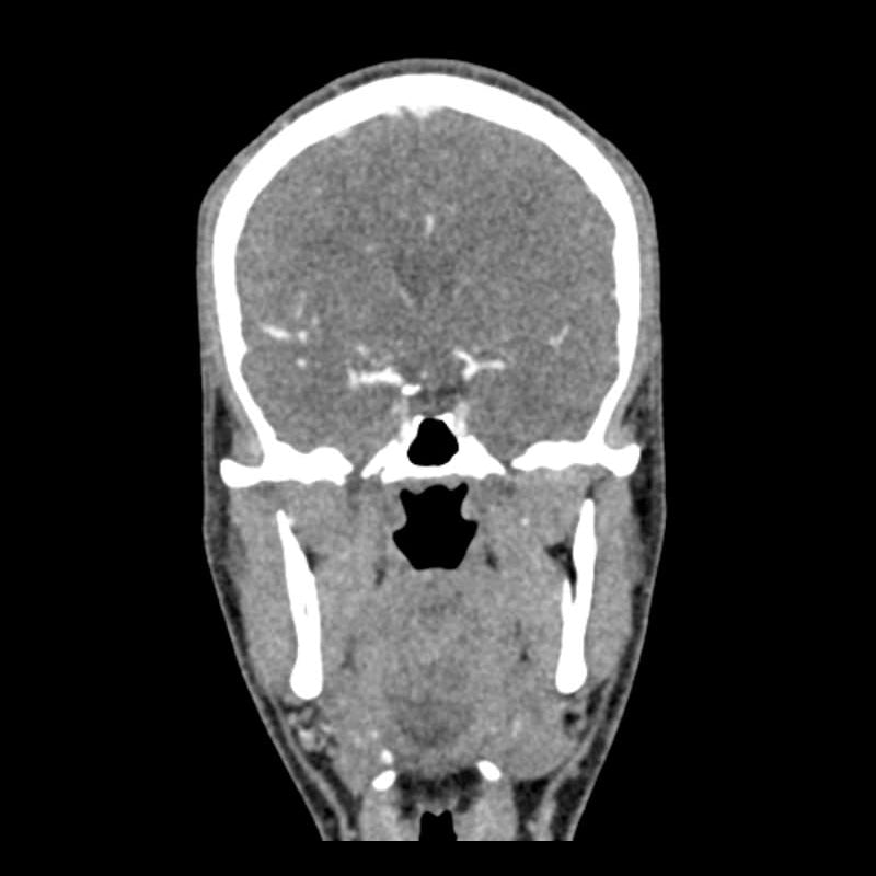 Head and Neck CTA Phantom AVM for CT Scan & X-Ray Training - Medical Imaging Practice, Radiology Education, and Diagnostic Testing