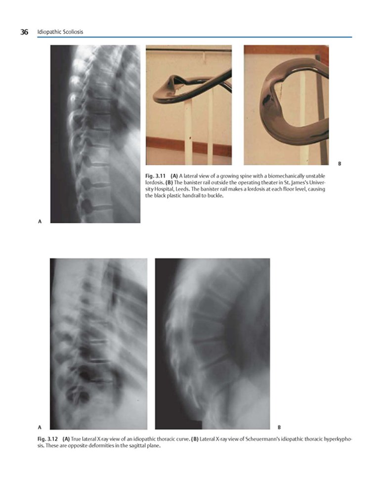 Idiopathic Scoliosis Treatment Guide - Harms Study Group Recommendations for Spinal Correction & Pain Relief | For Doctors, Physical Therapists & Patients