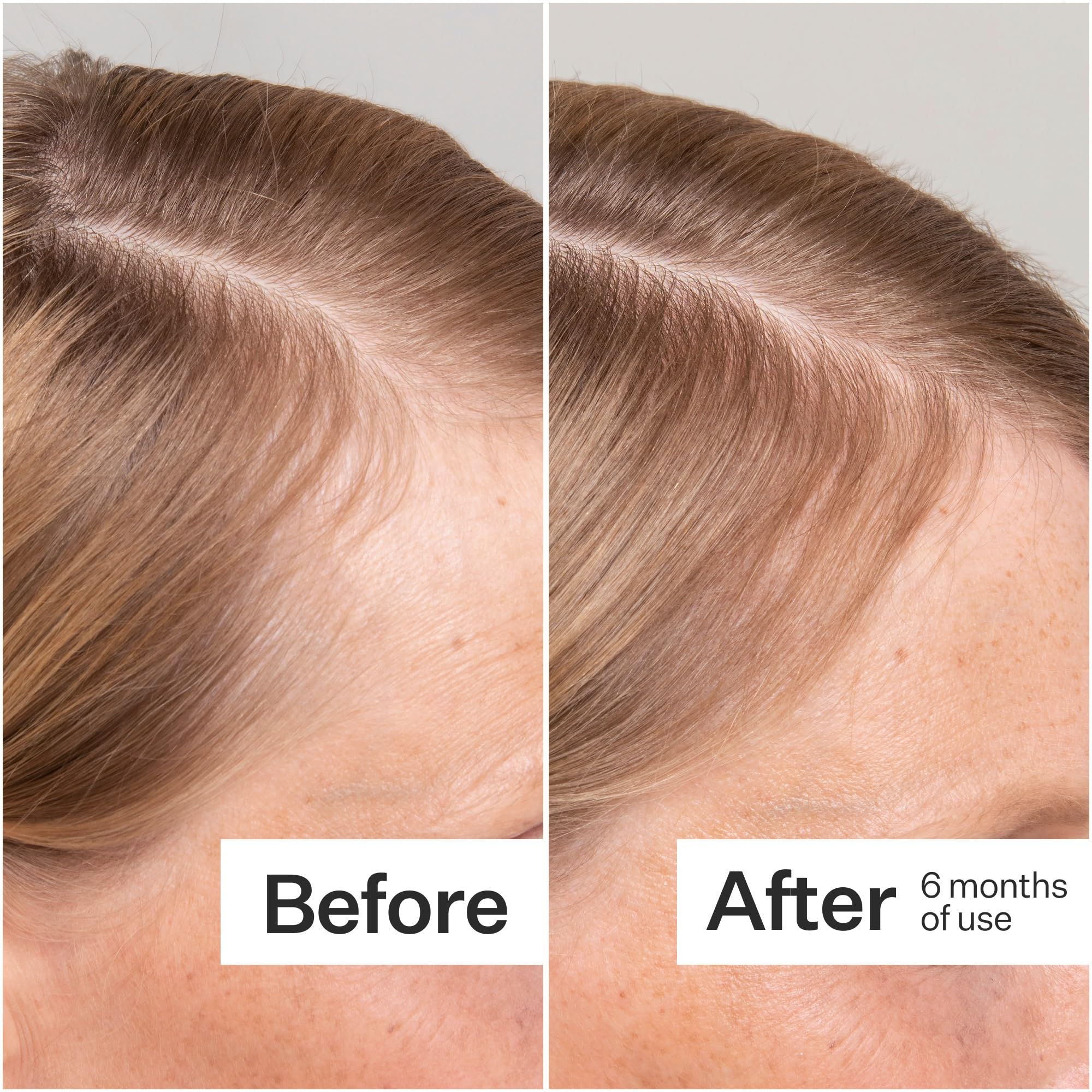 Act+Acre Cold Processed Stem Cell Scalp Serum for Thicker Hair Growth | Sulfate & Paraben Free Scalp Treatment with Aloe Vera | Hydrates & Soothes Dry Scalp | Perfect for Daily Hair Care Routine & Scalp Health Maintenance