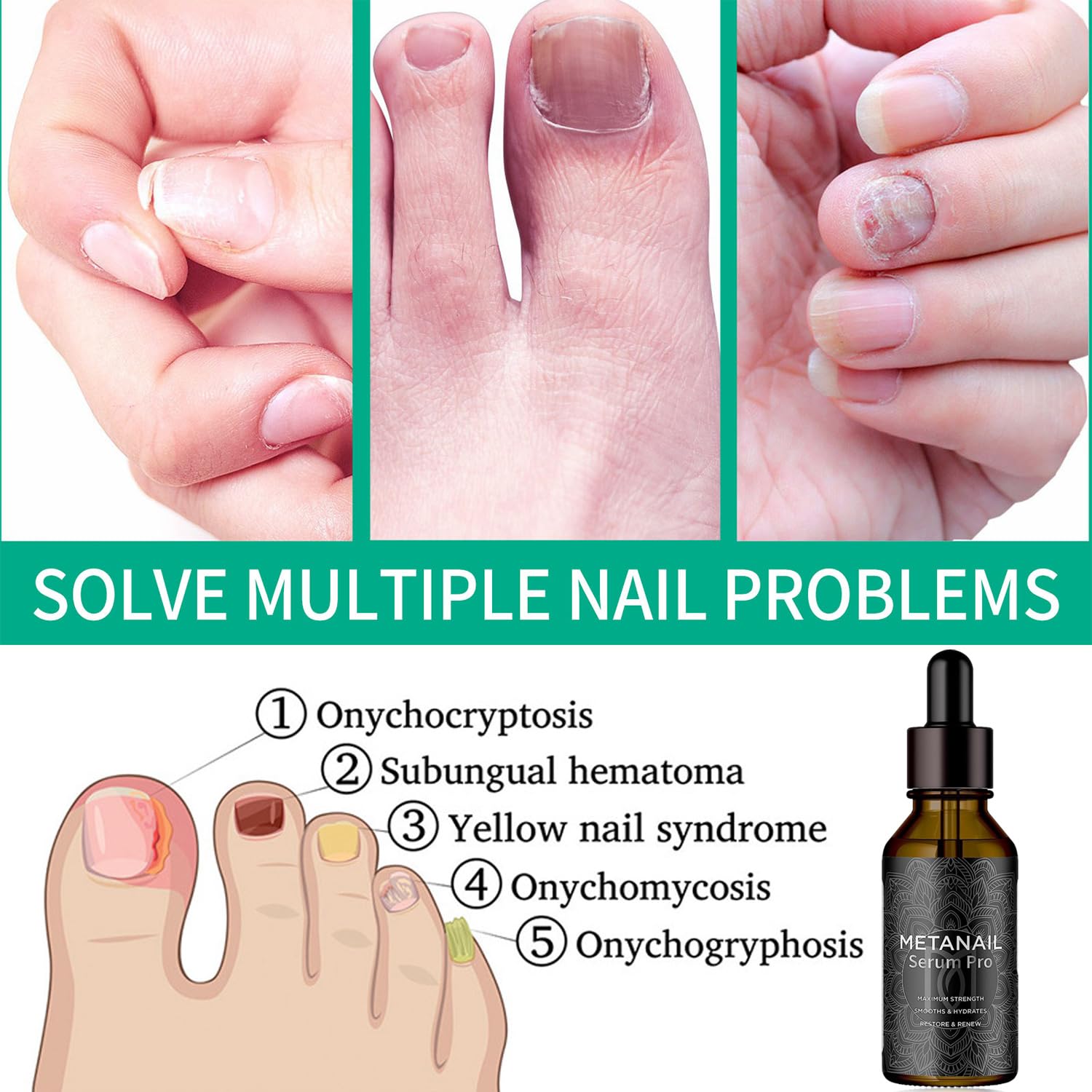 Metanail Extra Strength Toenail Treatment - Repair Damaged & Discolored Nails | Fungal Nail Growth Solution for Healthy Feet | Perfect for Athletes & Daily Foot Care