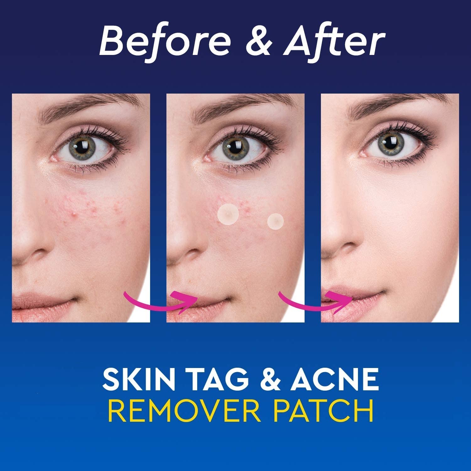 BLAGO Hydrocolloid Acne Pimple Patches for Face - 72 Count Spot Treatment for Blemishes & Breakouts | Effectively Calms & Relieves Acne | Perfect for Overnight Spot Treatment & Daily Facial Care