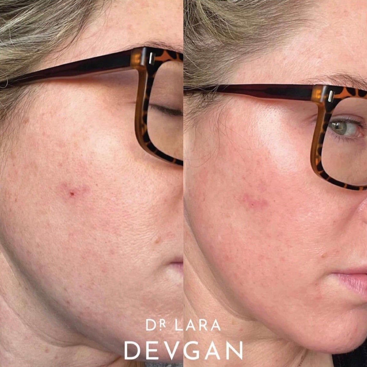 Dr. Devgan Vitamin C + B + E Ferulic Acid Serum for Face - Brightening, Anti-Aging & Hydrating Skincare Treatment - Perfect for Morning Routine & Sun Protection