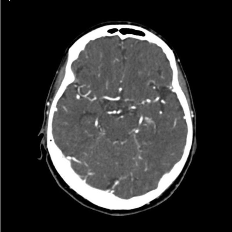 CTA Head Phantom for CT Scan & X-Ray Training - High-Quality Medical Imaging Education Tool for Radiology Students & Technicians