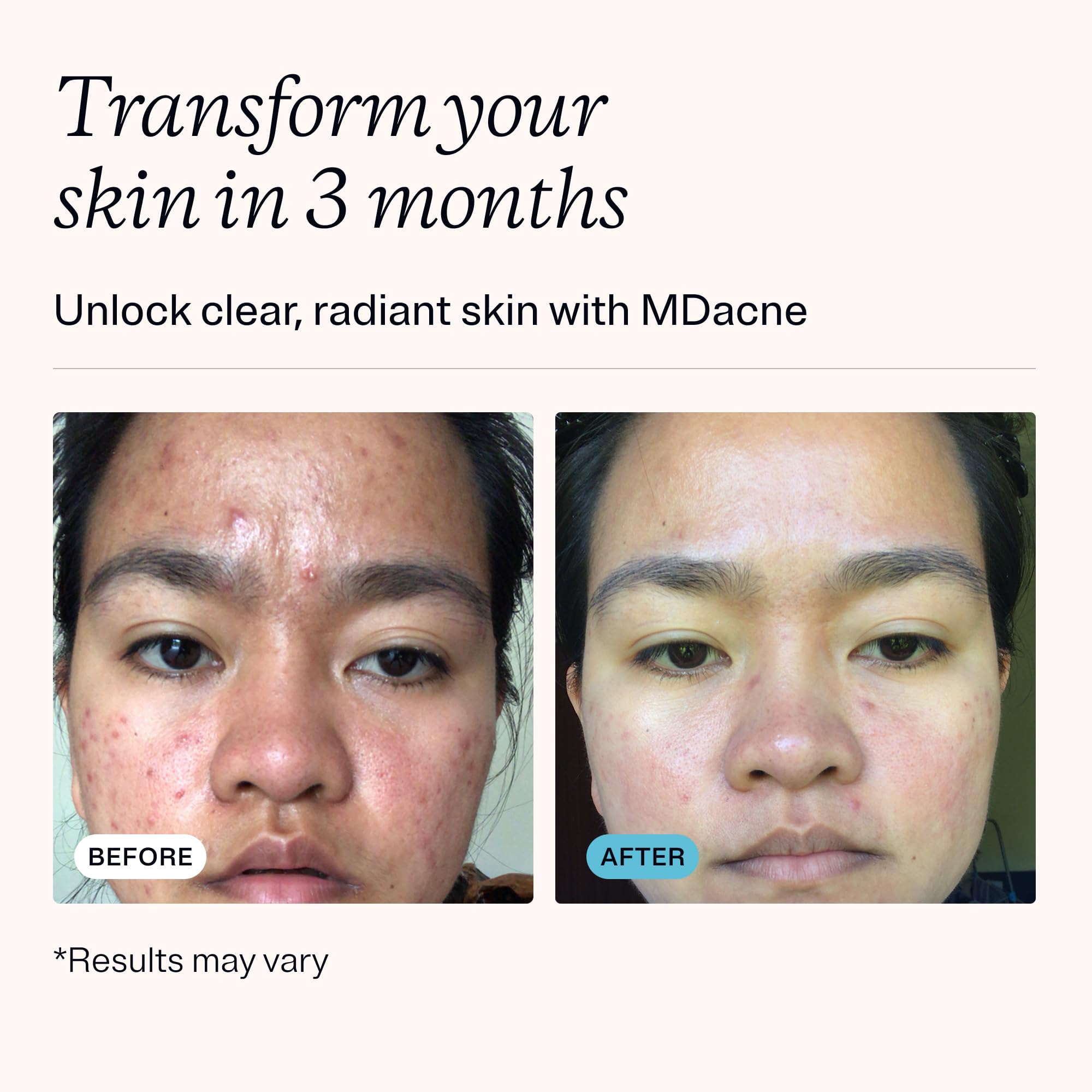 MDacne Acne Treatment Cream - 2.5% Benzoyl Peroxide for Clear Skin | Unclogs Pores, Reduces Blemishes | Plant-Based Formula for Sensitive Skin | Daily Face Care for Teens & Adults