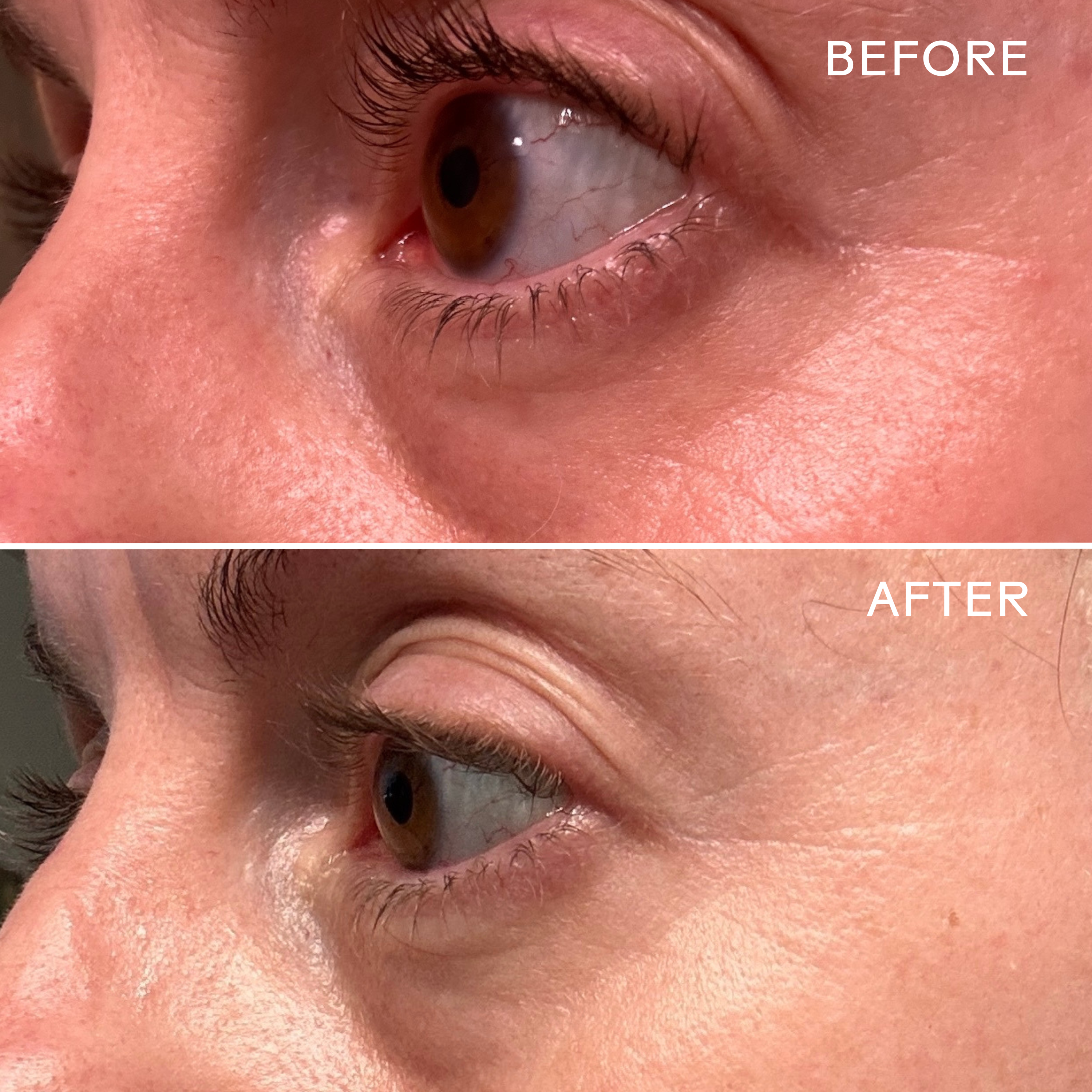 EyeHero™ Bio Retinol Smoothing Eye Cream - Anti-Aging & Wrinkle Reduction for Dark Circles & Puffiness - Perfect for Nighttime Skincare Routine & Travel