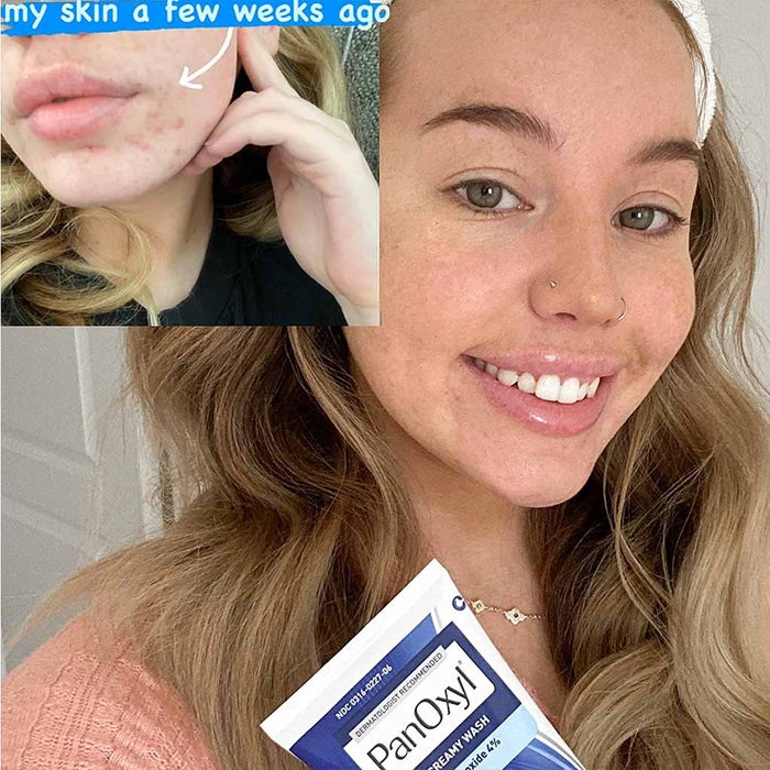 PanOxyl Acne Creamy Face & Body Wash with 4% Benzoyl Peroxide - 170g Cleanser for Acne-Prone Skin | Gentle Exfoliating & Oil Control | Perfect for Daily Skincare Routine & Post-Workout Cleansing