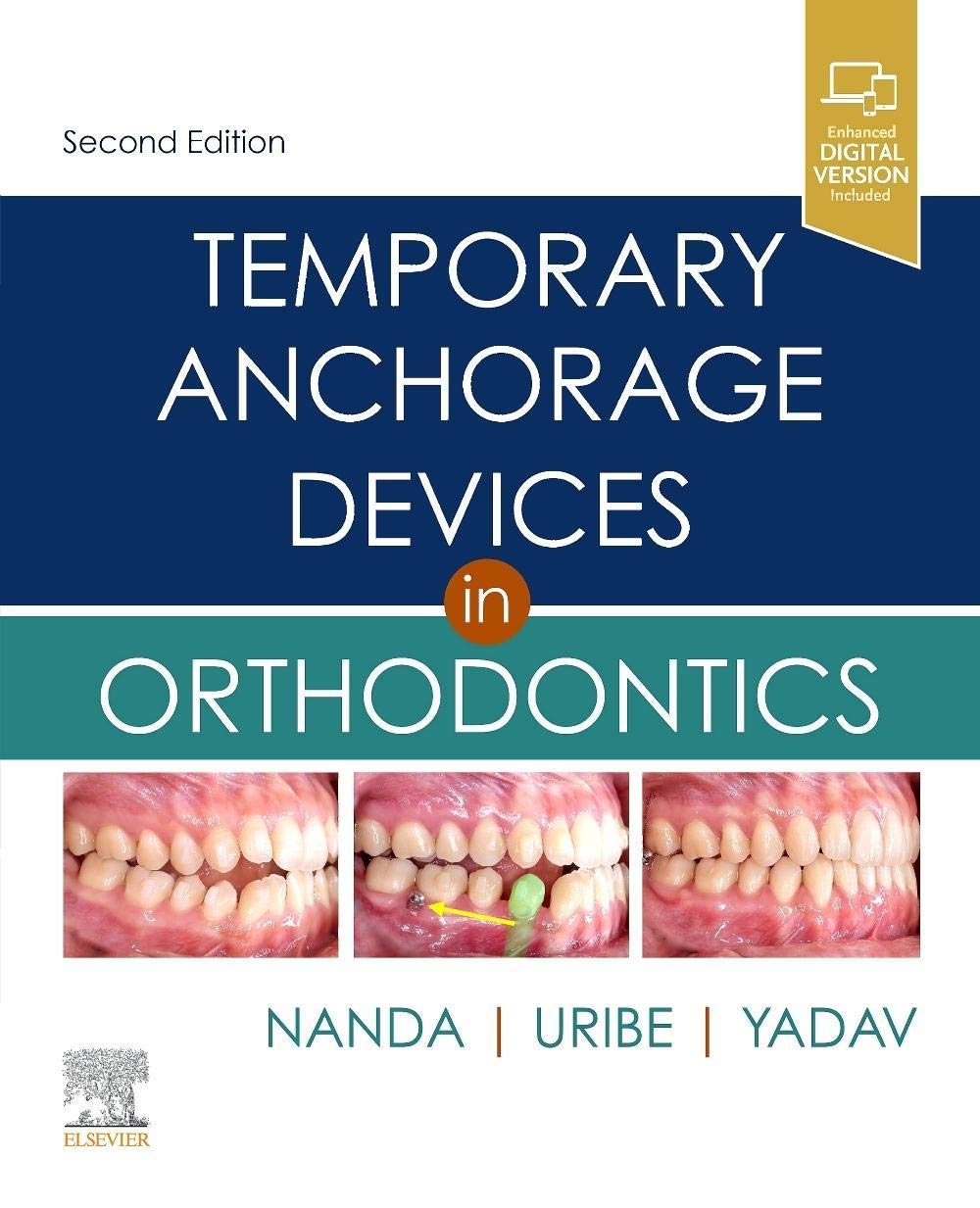 Orthodontic Temporary Anchorage Devices (TADs) - Mini Screws for Teeth Alignment & Dental Braces Support | Perfect for Orthodontic Treatment, Teeth Correction & Bite Adjustment