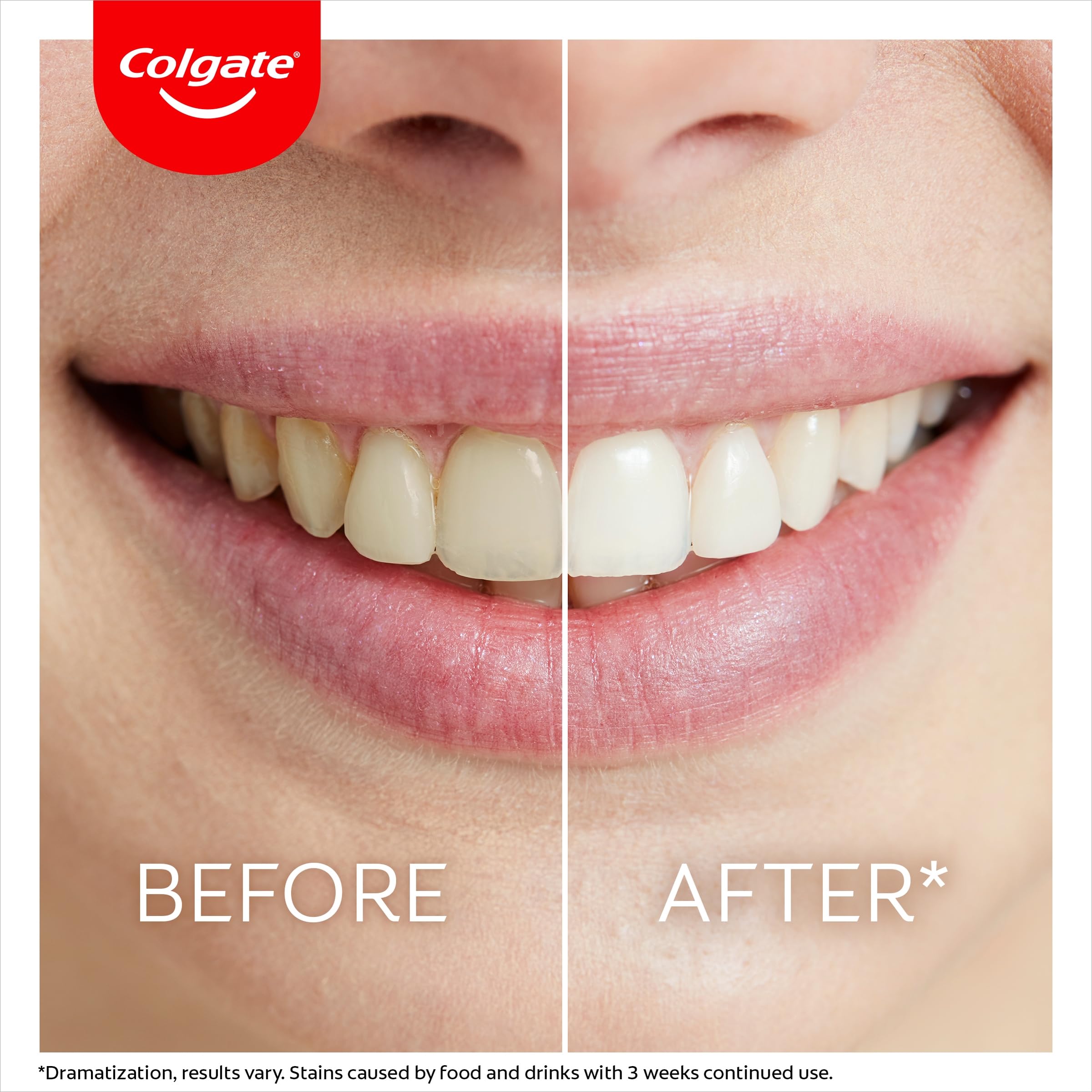 Colgate Max White Ultimate Overnight Teeth Whitening Pen - 2.5ml (1 Pack, 35 Nightly Treatments) for Removing 15 Years of Stains | Perfect for Travel & Nighttime Teeth Whitening Routine
