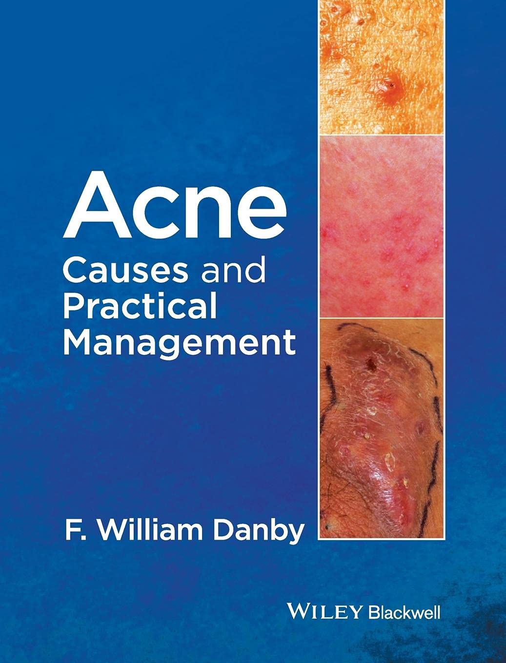 Acne Treatment & Prevention Guide - Causes, Solutions & Skincare Tips for Clear Skin | Best for Teens & Adults with Oily or Sensitive Skin