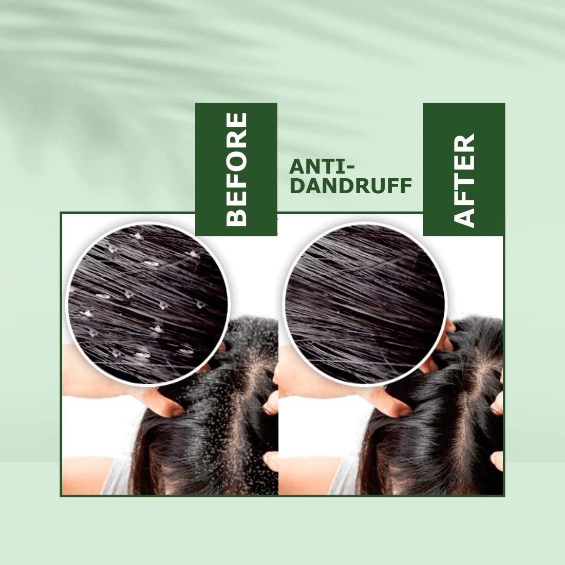 Nuerma Science Anti Dandruff Hair Oil 100ml - Tea Tree, Rosemary, Castor, Onion & Vitamin E Oil for Dandruff Control, Hair Fall Prevention & Hair Growth - Perfect for Scalp Care & Healthy Hair at Home