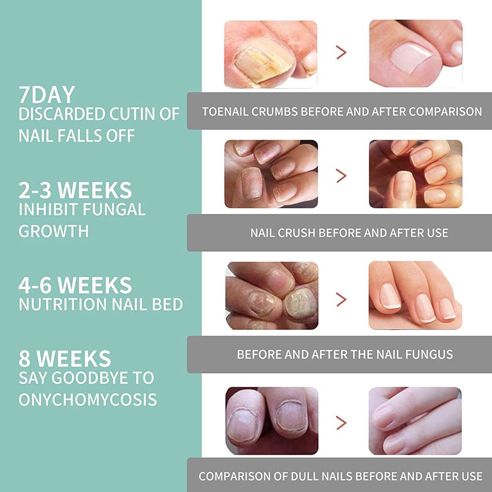 Nail Growth Serum & Repair Pen - Cuticle Oil Treatment for Toenail & Fingernails - Fungus Care & Damaged Nail Recovery (3 Pack) | Perfect for Home Manicures, Pedicures & Professional Salon Use