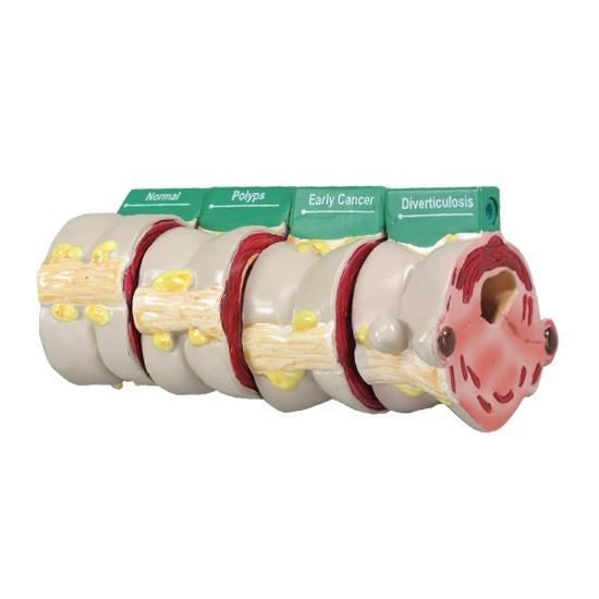 4-Piece Colon Anatomy Model with Pathologies - Ideal for Medical Students, Doctors & Healthcare Professionals