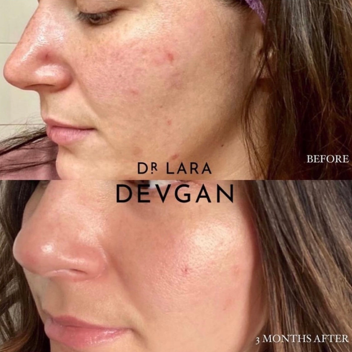 Dr. Devgan Vitamin C + B + E Ferulic Acid Serum for Face - Brightening, Anti-Aging & Hydrating Skincare Treatment - Perfect for Morning Routine & Sun Protection
