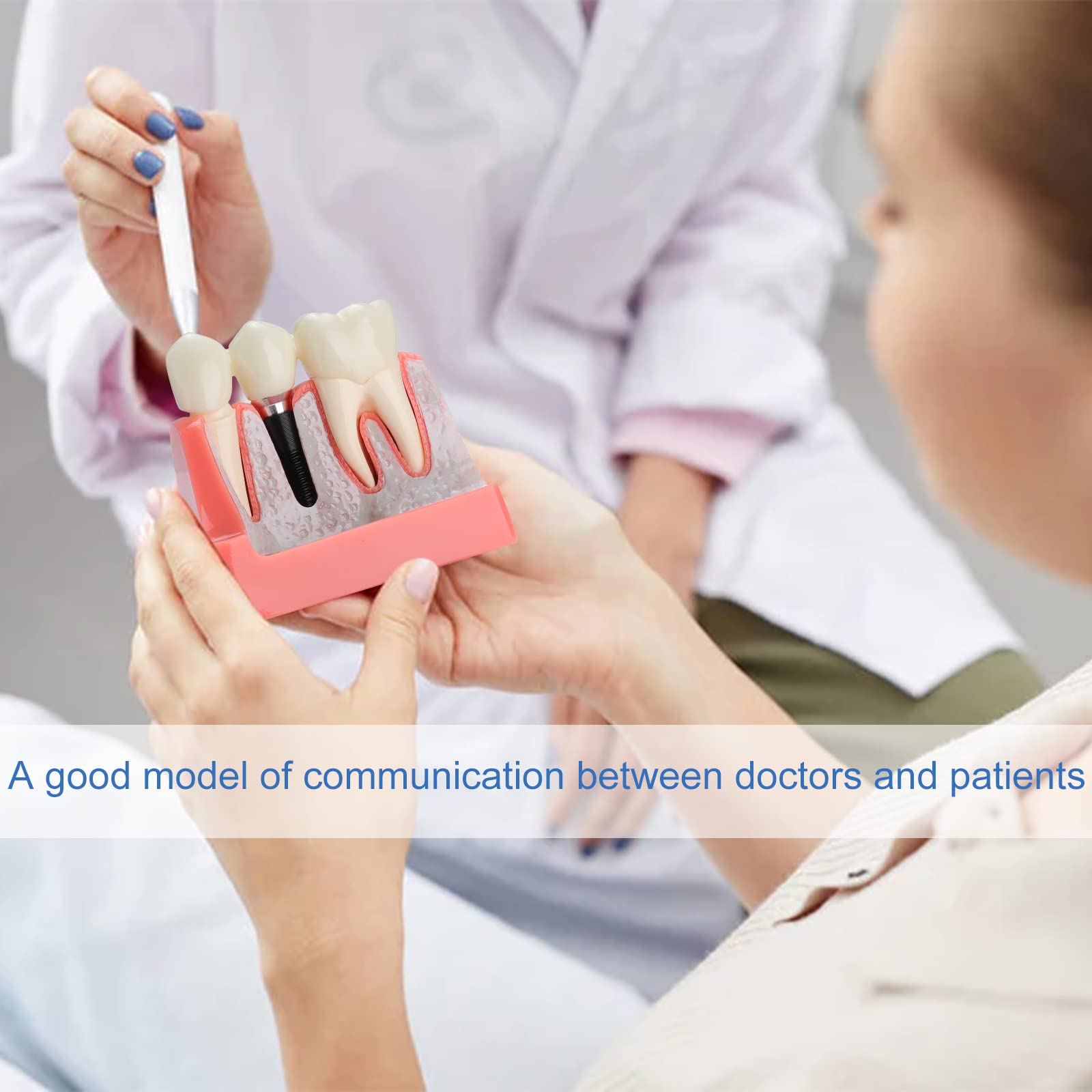 Dental Implant Model - 4X Removable Implant vs Bridge Demonstration Teeth for Dental Education & Practice | Perfect for Dental Students, Professionals & Training Clinics