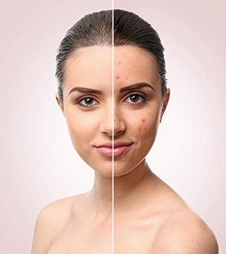 Rida Herbal Special Pimple & Acne Removal Face Mask with 19 Natural Ingredients - Neem & Lal Chandan for Women & Men | Clear Skin Treatment for Acne-Prone Face | Perfect for Daily Skincare Routine & Spa Days
