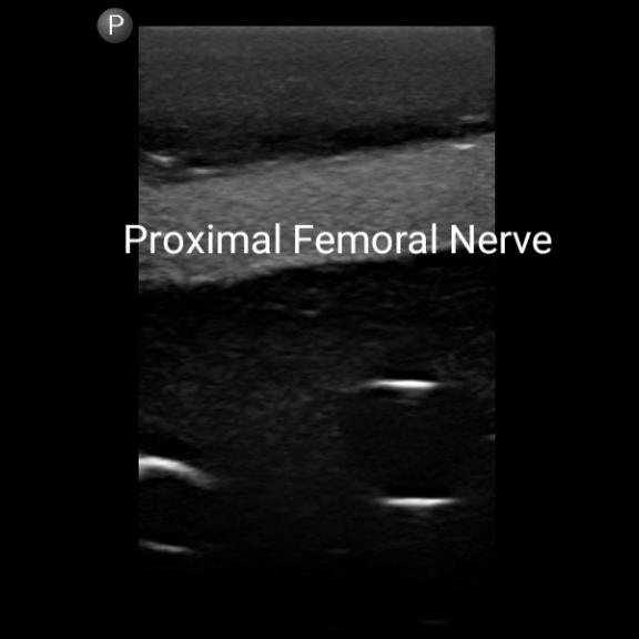 Gen II Femoral Vascular Access & Regional Anesthesia Ultrasound Training Model - Medical Simulation for Ultrasound-Guided Procedures Practice