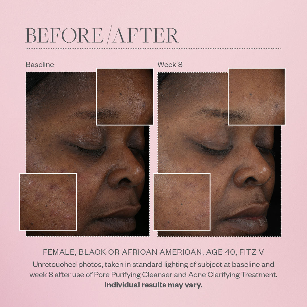 Best Acne Clarifying Treatment for Clear Skin - Anti-Blemish Solution for Face & Body - Perfect for Daily Skincare Routine & Acne-Prone Skin Care