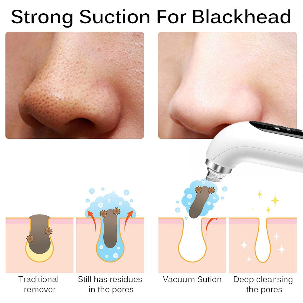 Professional USB-Powered Blackhead Remover Vacuum - Portable Pore Cleaner for Face & Nose - Perfect for Home Spa & Skincare Routine