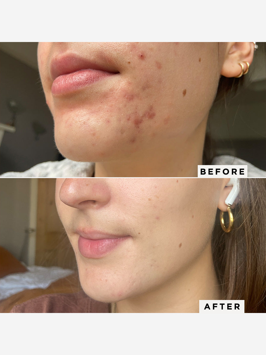 Flawless Neutralizing Gel for Dark Spots & Hyperpigmentation - Brightening Skincare Treatment for Face & Body - Perfect for Daily Use & Nighttime Routine