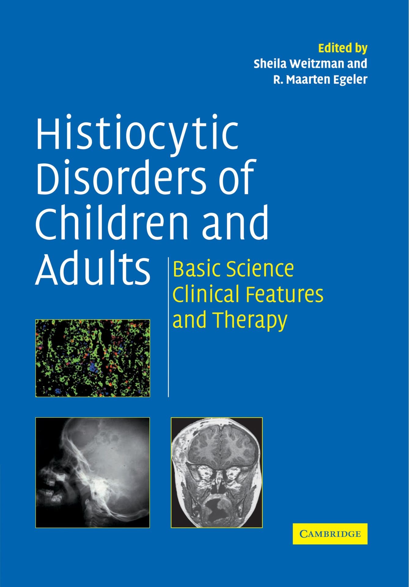 Histiocytic Disorders in Children and Adults: Diagnosis, Treatment & Clinical Features | Pediatric & Adult Hematology | Hospital & Home Care Use