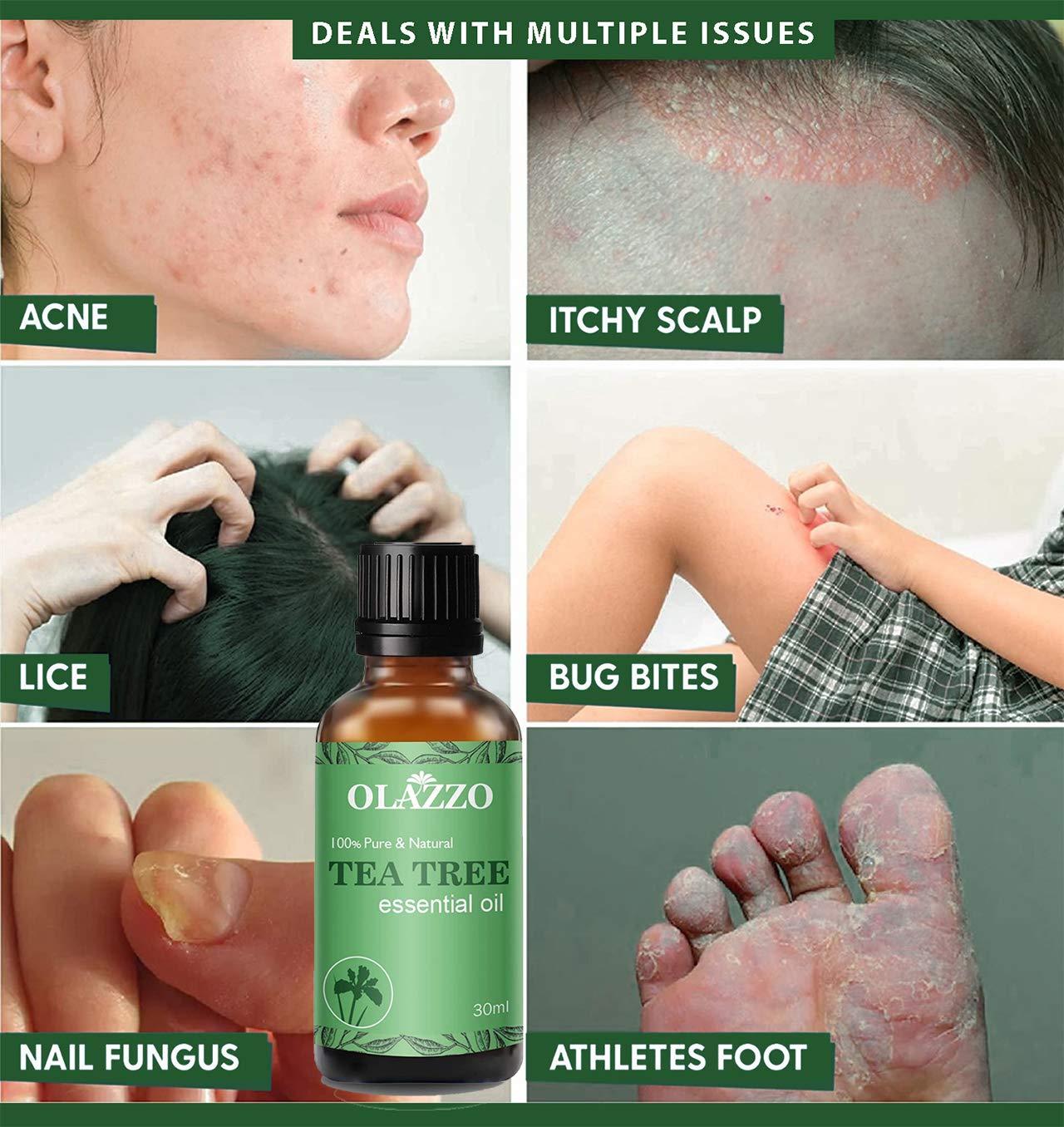 Pure Tea Tree Essential Oil for Skin, Hair & Face - 100% Natural Steam Distilled Treatment for Acne, Dandruff & Healthy Nails | 30ml Organic Oil for Aromatherapy, DIY Beauty & Home Remedies
