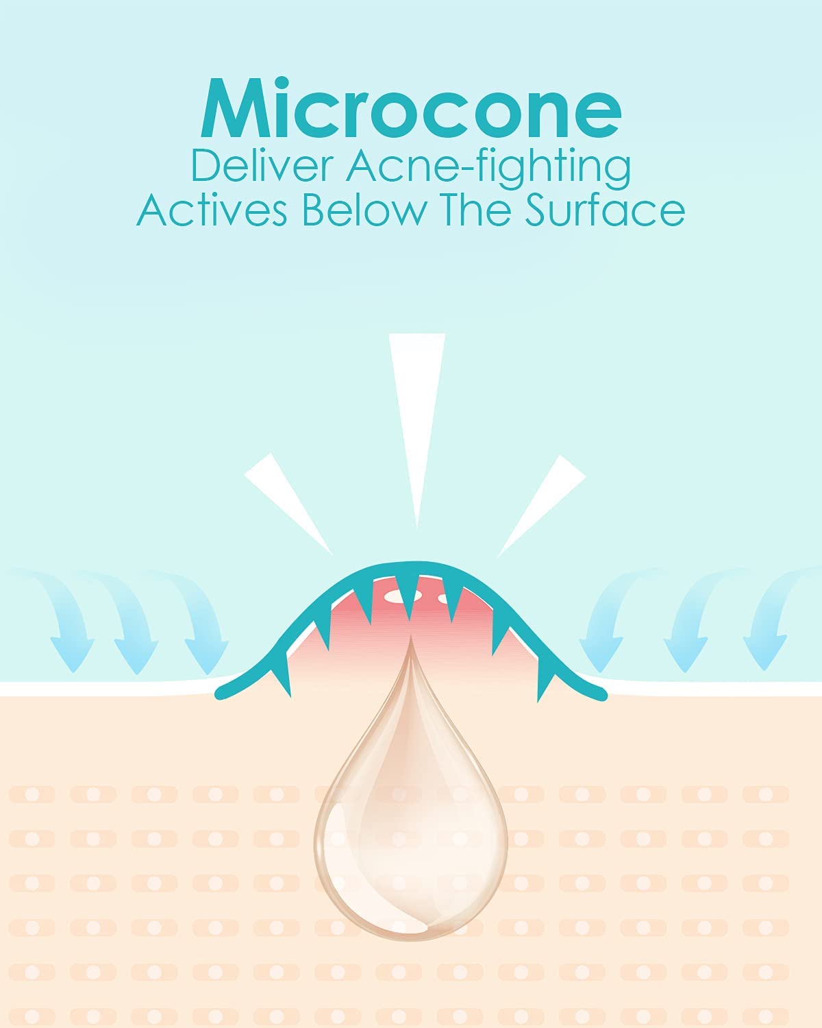 Microdart Acne Patches (36 Count) - Hyaluronic Acid & Salicylic Acid Hydrocolloid Pimple Patches for Deep, Early & Hidden Breakouts - Fast-Acting Spot Treatment for Overnight Blemish Relief - Perfect for Travel & Daily Skincare Routine