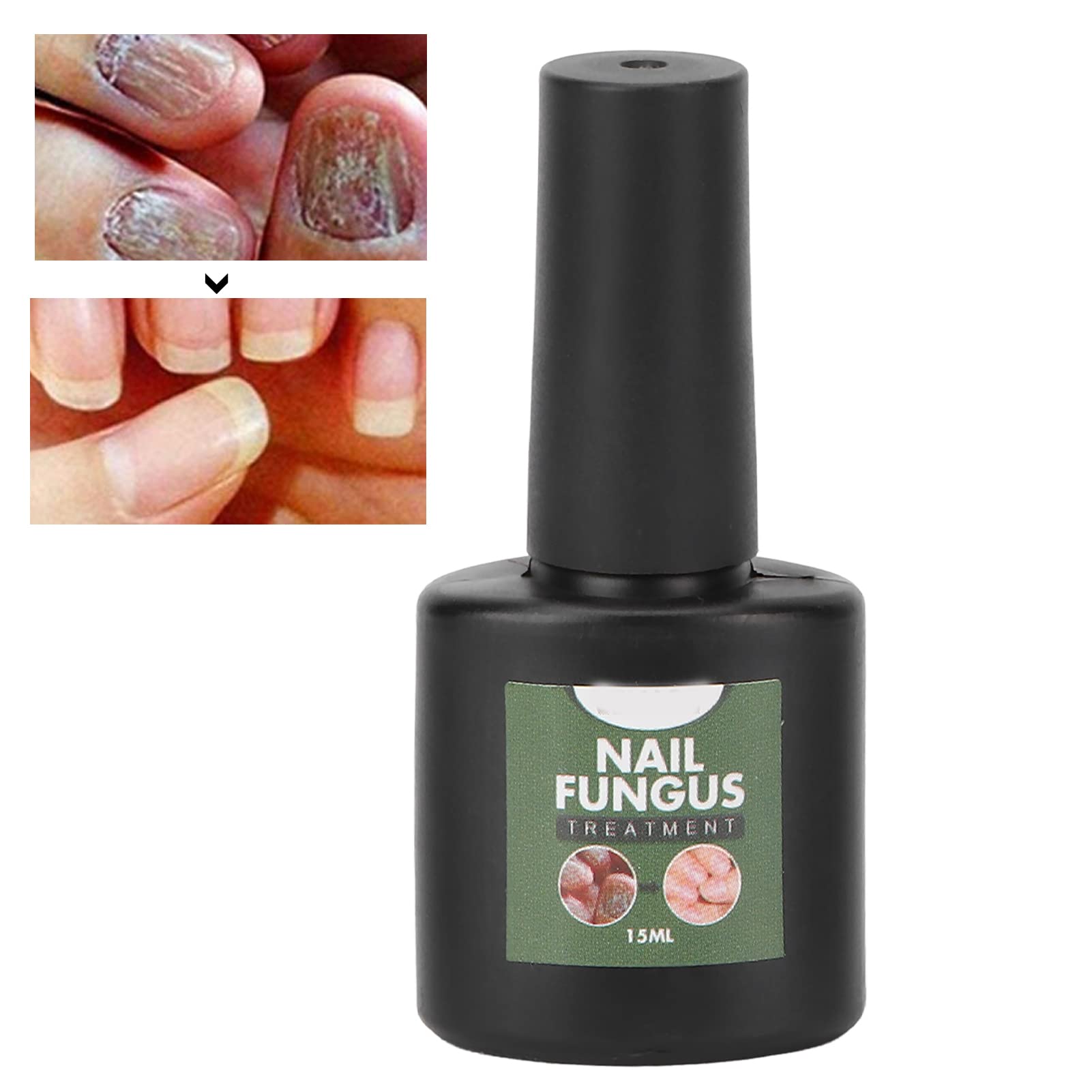 15ml Nail Repair Serum - Strengthen & Treat Brittle Nails, Onychomycosis Solution - Fast-Acting Nail Care Treatment for Damaged & Weak Nails - Perfect for Home Manicures & Professional Salon Use