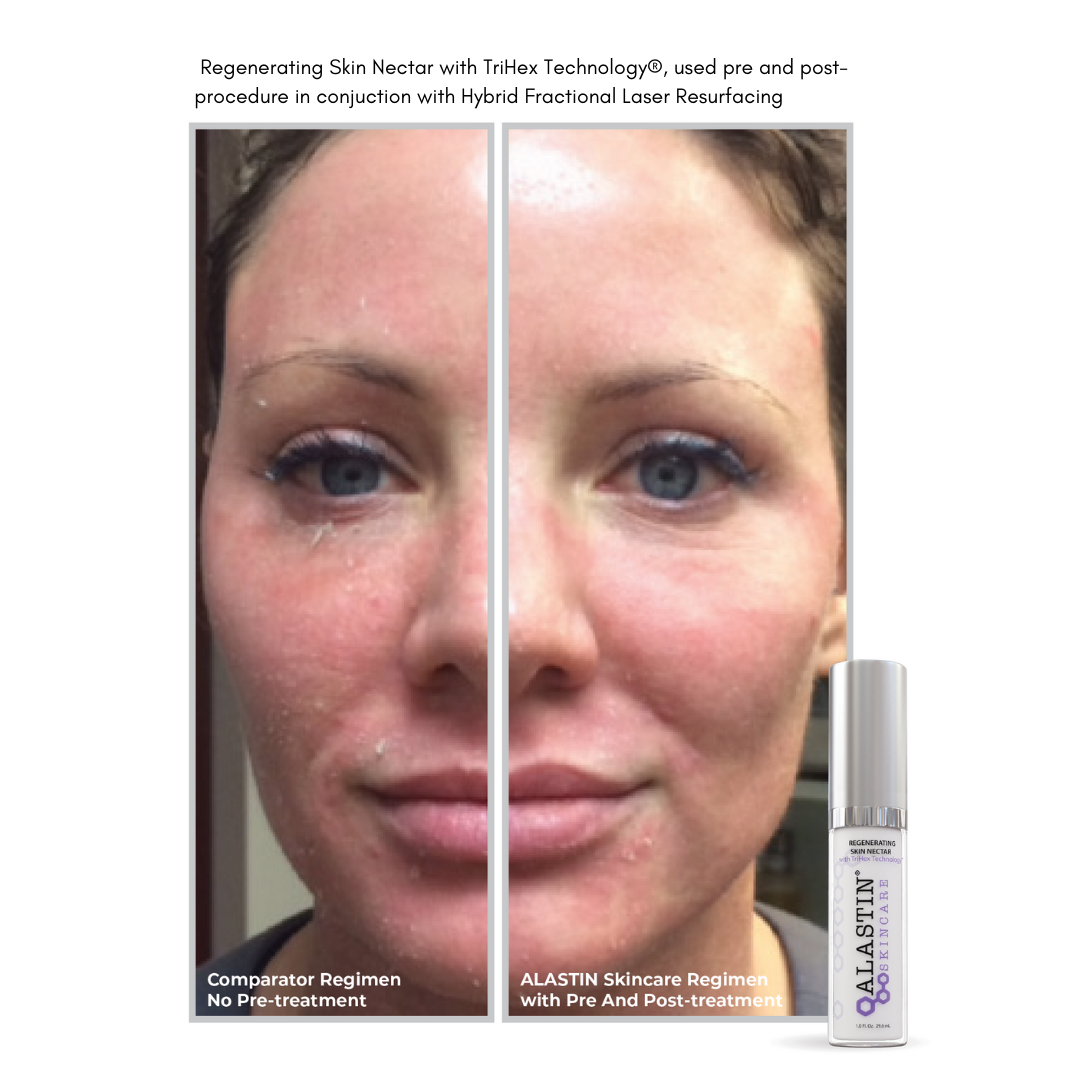Alastin Regenerating Skin Nectar - Anti-Aging Facial Serum with TriHex Technology for Wrinkles & Fine Lines | Dermatologist Recommended Skincare for Daily Use & Post-Procedure Recovery