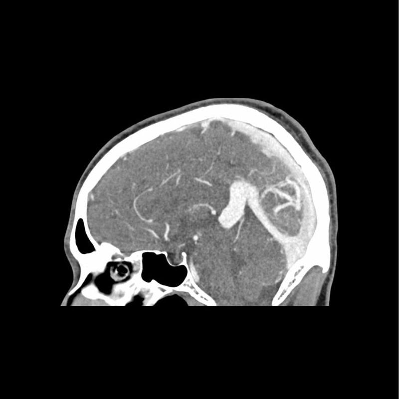 CTA AVM Head Phantom for CT Scan & X-Ray Training - Medical Imaging Practice, Radiology Education & Diagnostic Testing Simulation