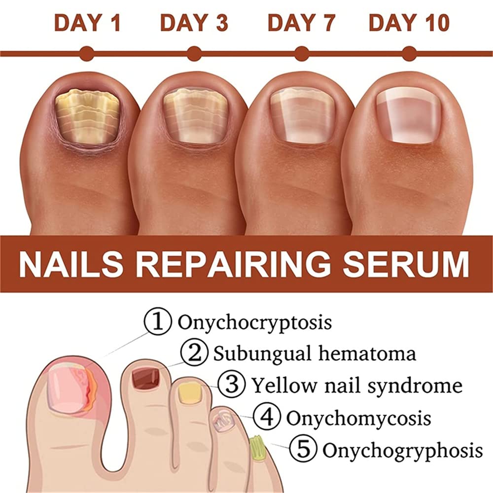 Pisheng 7-Day Nail Growth & Strengthening Serum - 20ml (2-Pack) | Fast Nail Treatment for Stronger, Healthier Nails | Perfect for Brittle Nails & Nail Care Routine