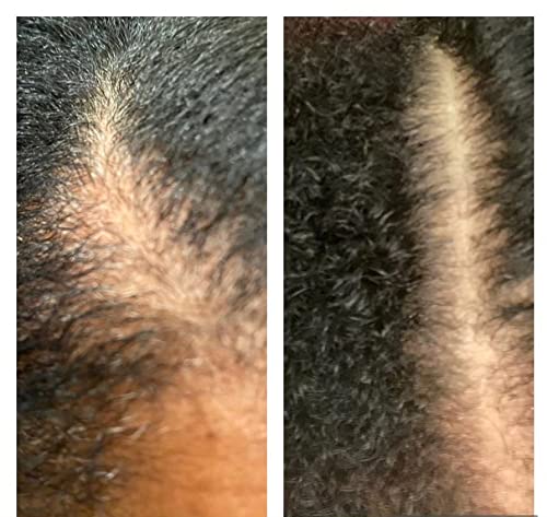 Elite Hair Growth Enhancer for Men & Women - Natural Hair Regrowth Treatment for Thicker, Fuller Hair - Perfect for Daily Use & Scalp Care