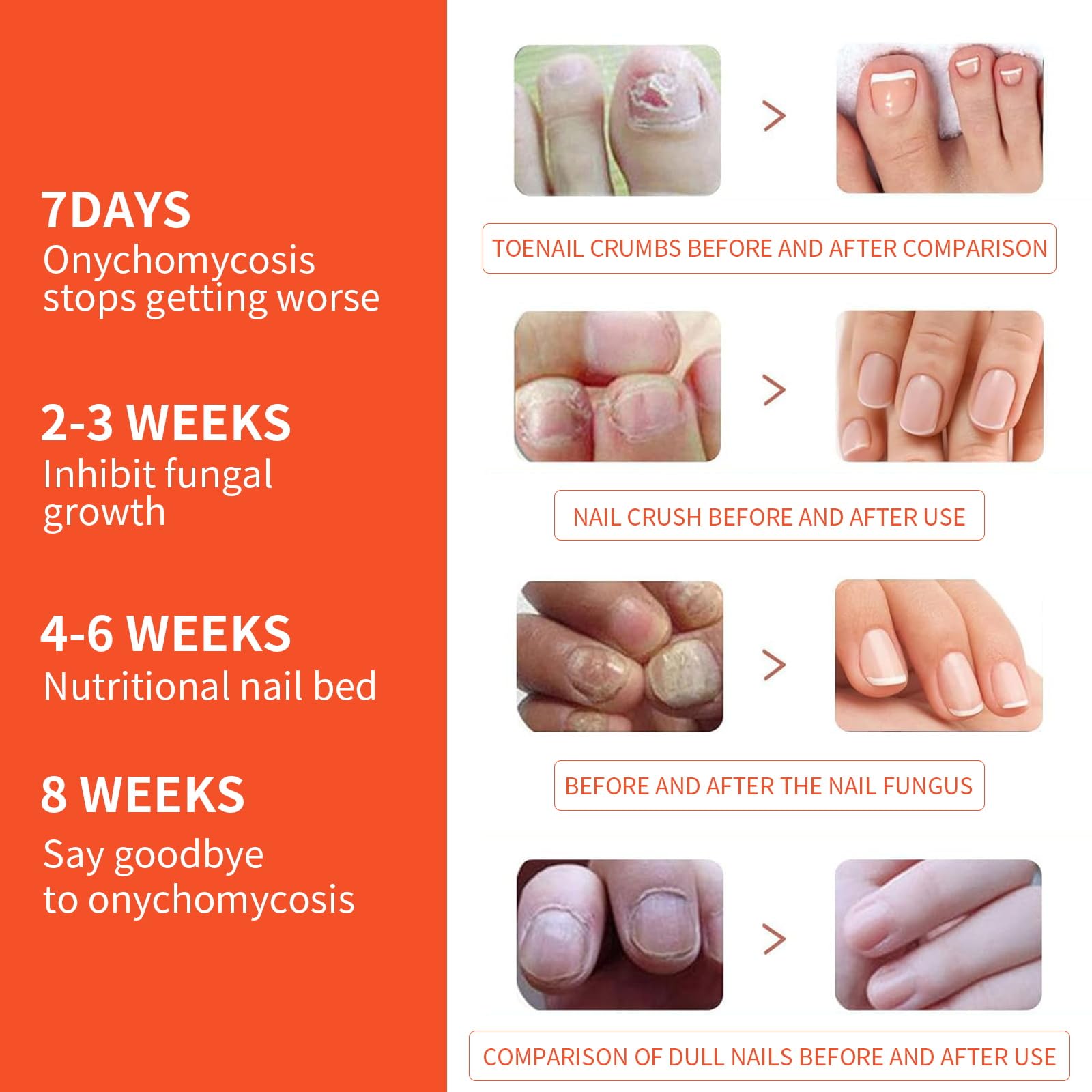Extra Strength Toenail Fungus Treatment - 32 Pcs Nighttime Renewal Patches for Effective Symptom Relief & Visible Results | Fungal Nail Care for Athletes, Swimmers & Diabetics
