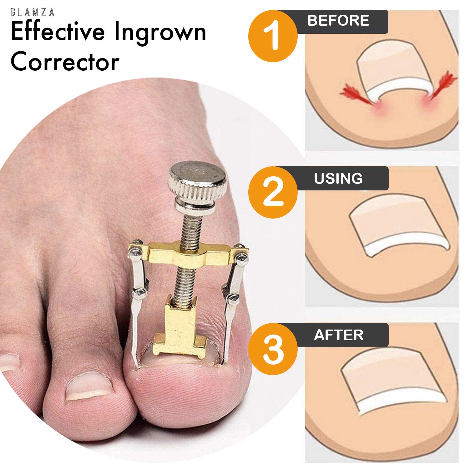 SKINAPEEL Ingrown Toenail Treatment Kit - Toe Nail Softener, Correction Oil & Clamp Tool for Pain Relief | At-Home Pedicure & Foot Care Solution