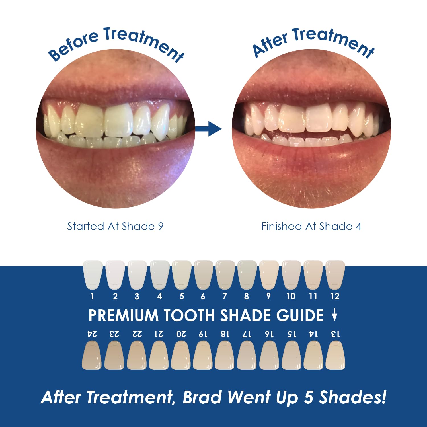 Professional Dental-Grade Teeth Whitening Gel - 9% Hydrogen Peroxide Formula for Sensitive Teeth - Made in USA - 30 Pack Syringes with Dispensing Tips - Perfect for At-Home Whitening & Professional Dental Use