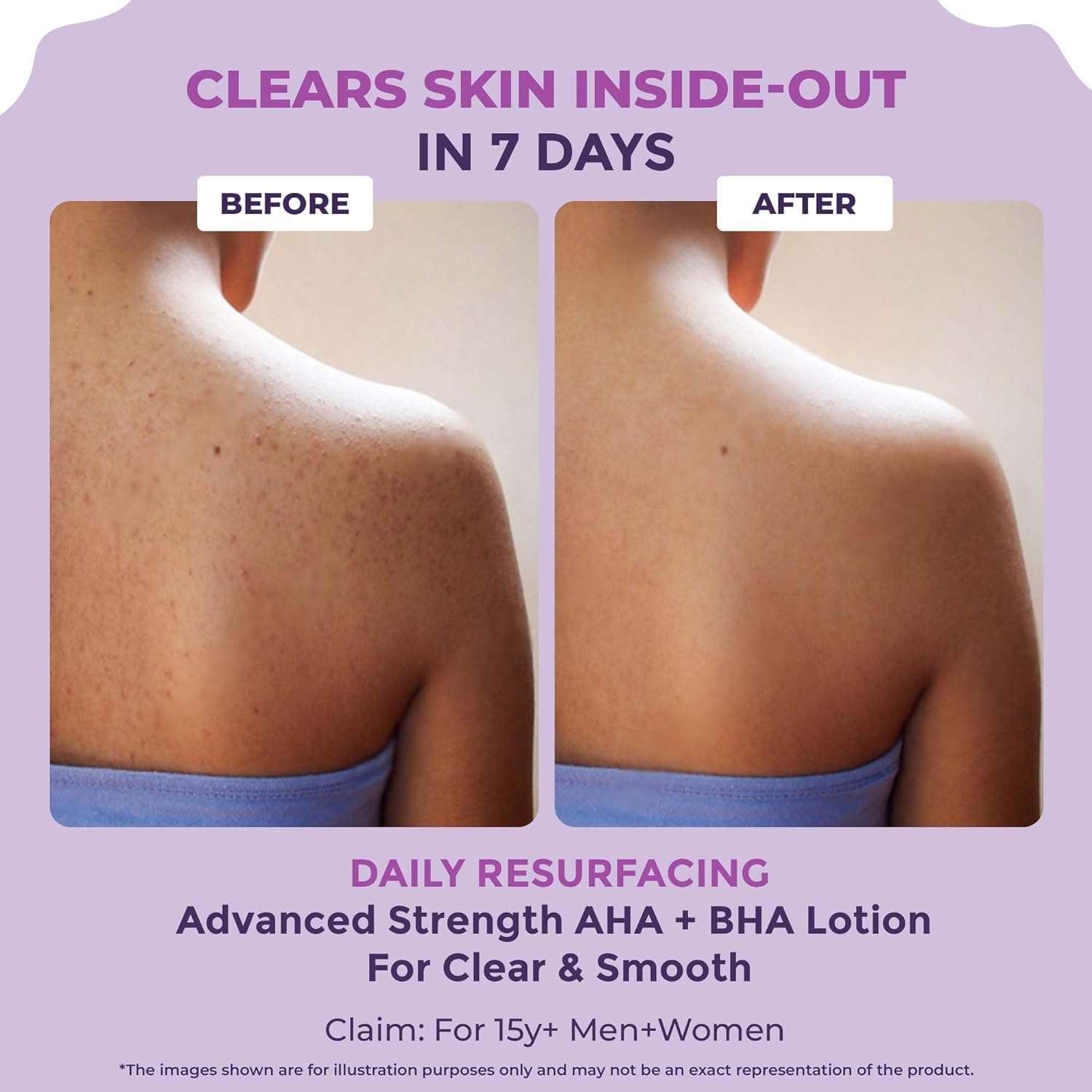 RI Clear & Confident Glycolic Acid Body Lotion - Daily AHA Exfoliator for Rough & Bumpy Skin, Tan Removal, Acne Treatment & Strawberry Skin Care - With Niacinamide & Lactic Acid - Smooth Skin from First Use (200ml) | Perfect for Daily Skincare Routine & Post-Shaving Care