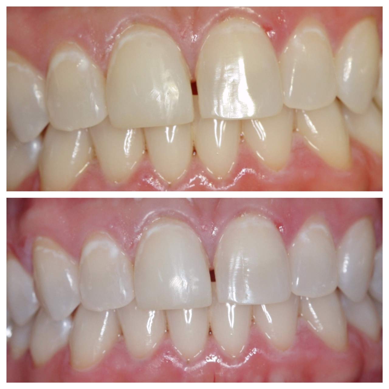 22% Teeth Whitening Gel - 5 Large Tubes (3.8ml Each) for Whiter Teeth & Brighter Smile | Professional Dental Care at Home for Special Occasions & Daily Confidence Boost