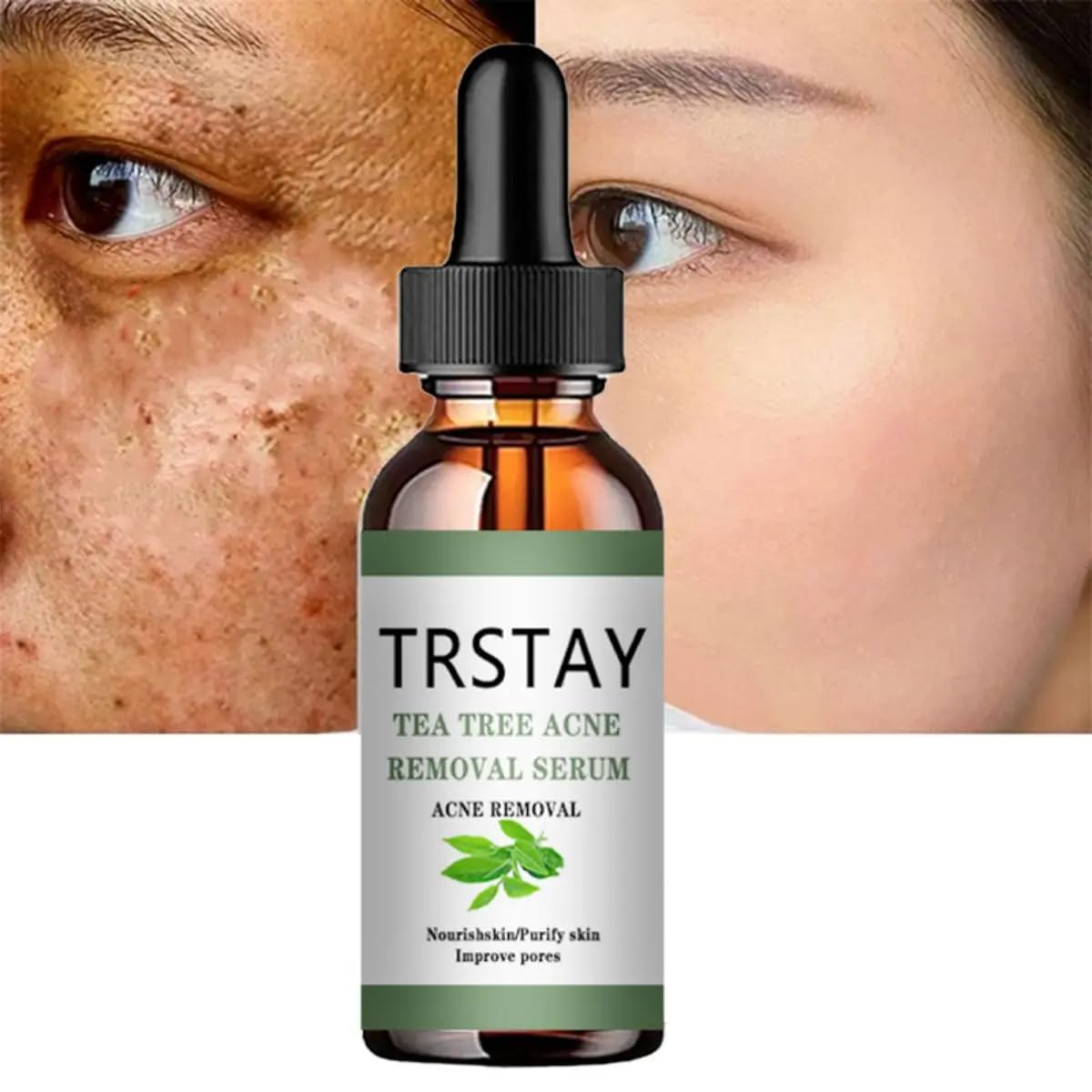 Tea Tree Oil Acne Treatment Face Serum - Korean Skin Care for Moisturizing, Pore Minimizing & Acne Relief | Perfect for Oily, Acne-Prone Skin & Daily Skincare Routine