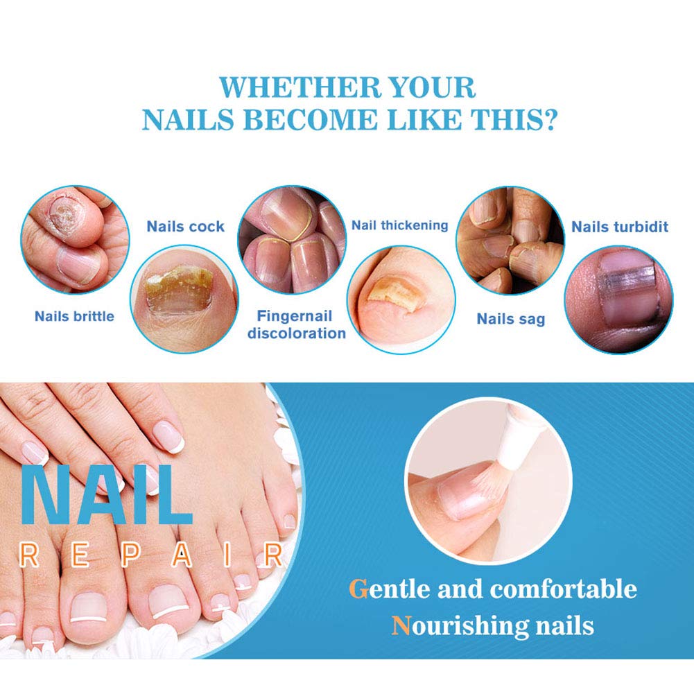 Ofanyia Anti-Fungal Nail Treatment Pen for Toenail & Fingernail Fungus Repair - Strengthens Brittle Nails & Promotes Healthy Growth - Effective Nail Care Solution for Athletes, Swimmers & Daily Use