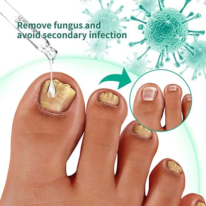 Kerassentials Toenail Fungal Treatment Oil - Extra Strong Foot & Nail Repair Kit for Fungus Relief | Athlete's Foot Care, Nail Restoration for Healthy Toes