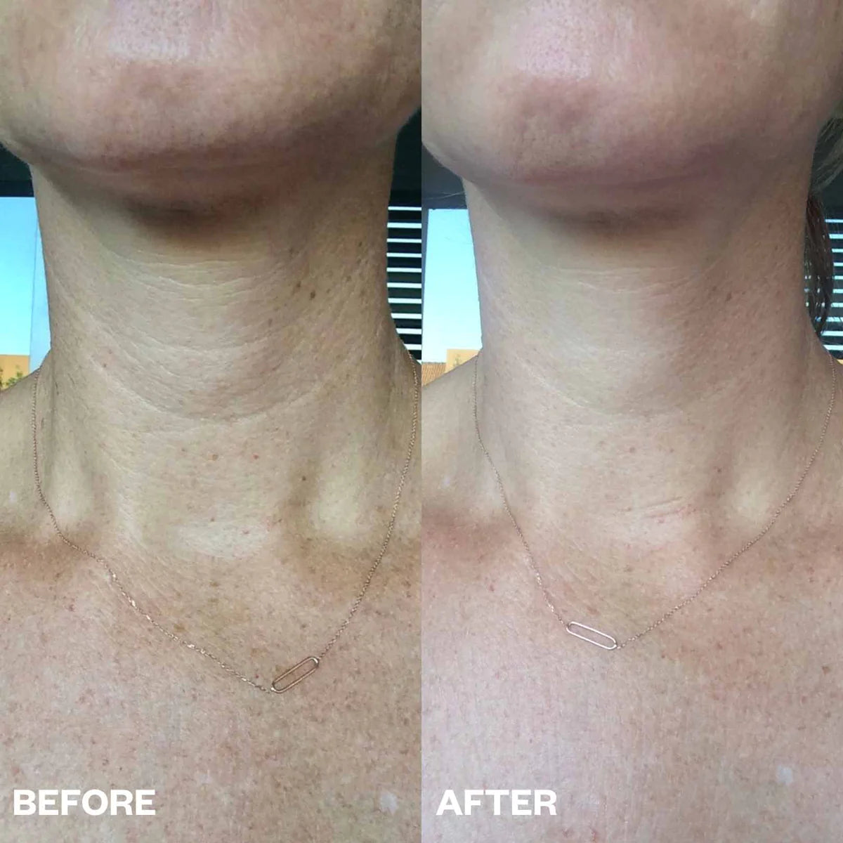 Anti-Aging Neck Wrinkle Patches - Rejuvenating Collagen Treatment for Smooth Skin | Reduce Fine Lines & Wrinkles | Perfect for Nighttime Skincare Routine & Special Occasion Prep