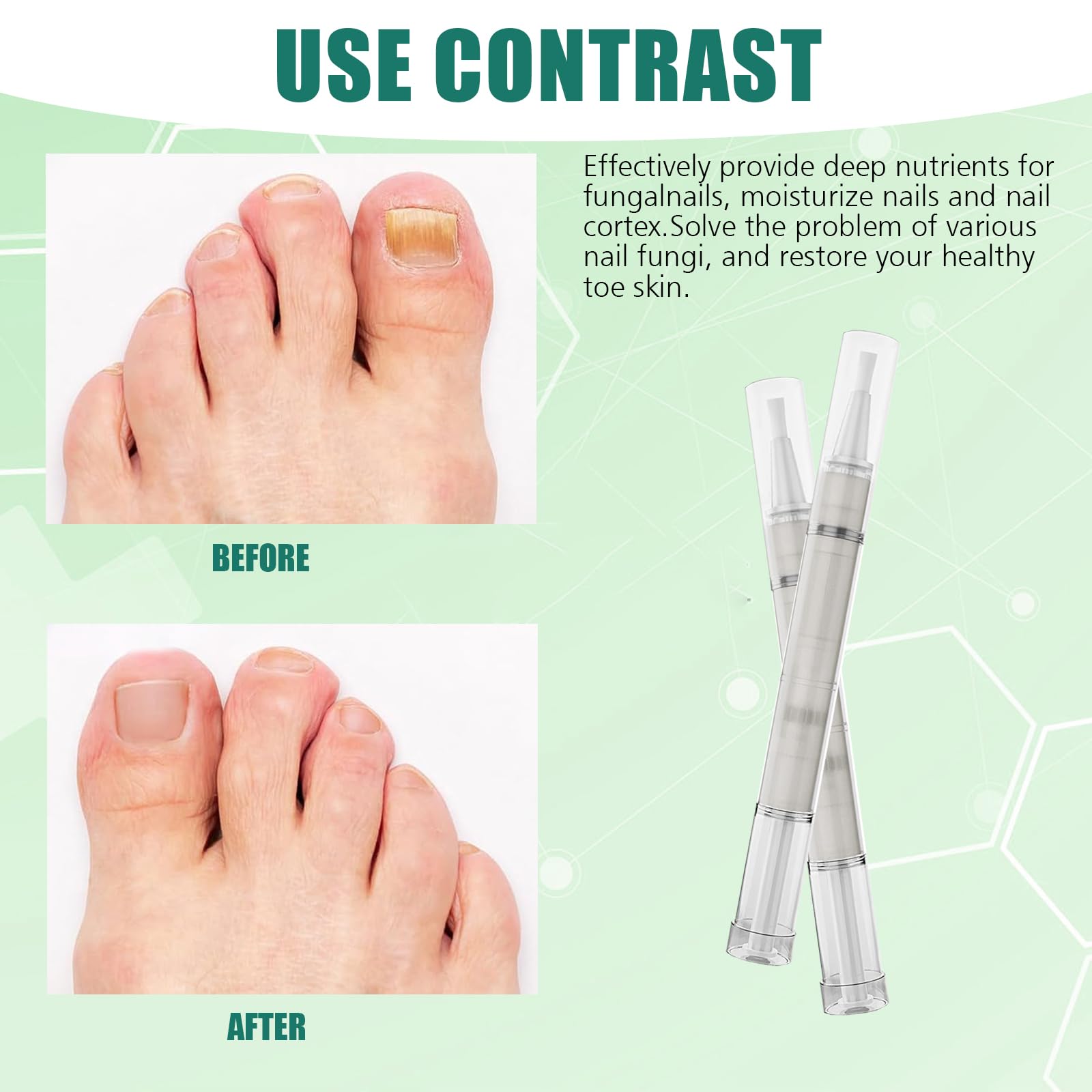 5-Piece Supplend Nail Care Pen Set with Tea Tree Oil - Fast & Intensive Nail Treatment for Dry, Damaged Cuticles - Perfect for Home Manicures & Salon Use